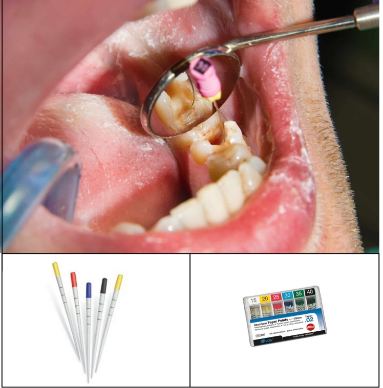 کاربرد کن کاغذی در درمان ریشه