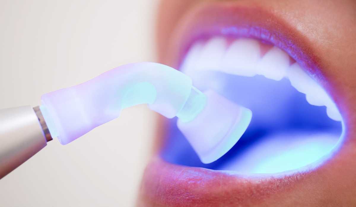 باندینگ دندان