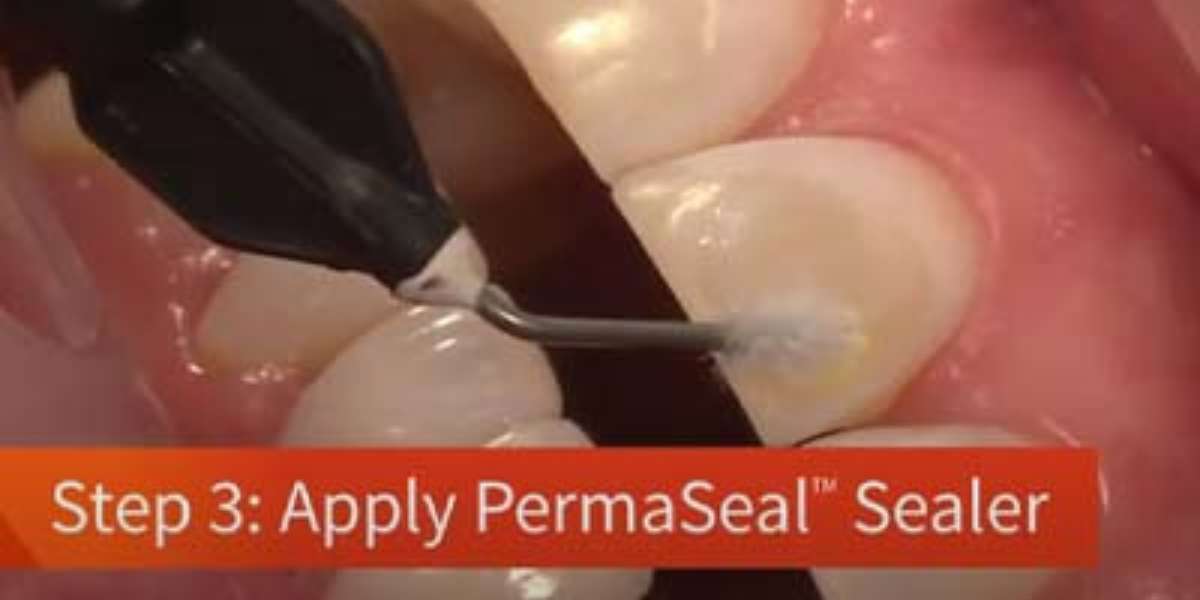 کاربرد گلیز در دندانپزشکی