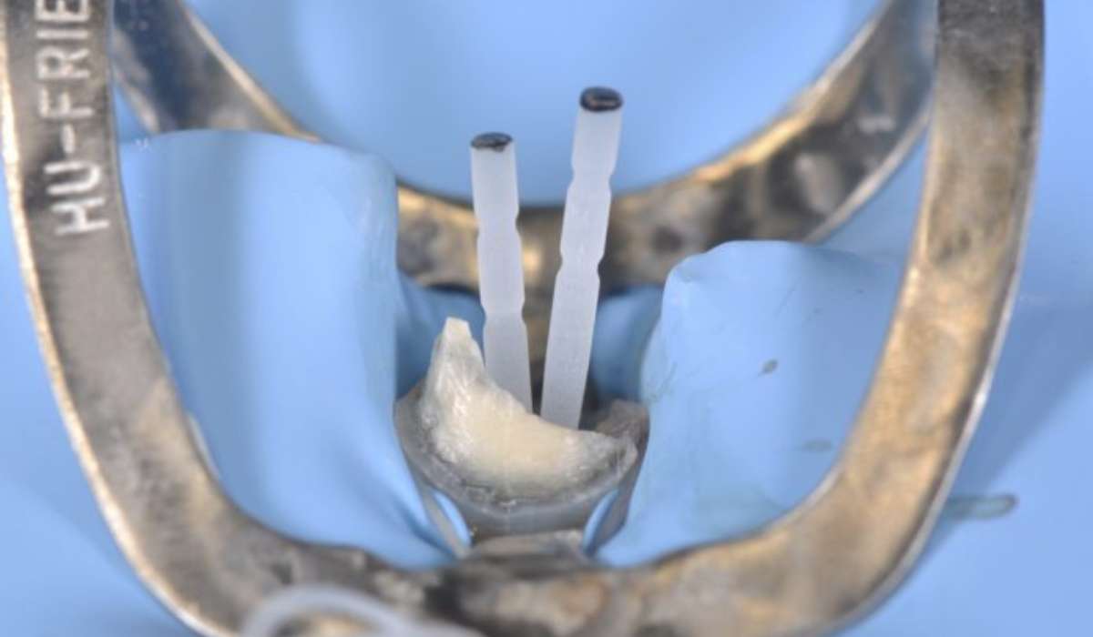 فایبر پست دندانپزشکی چیست