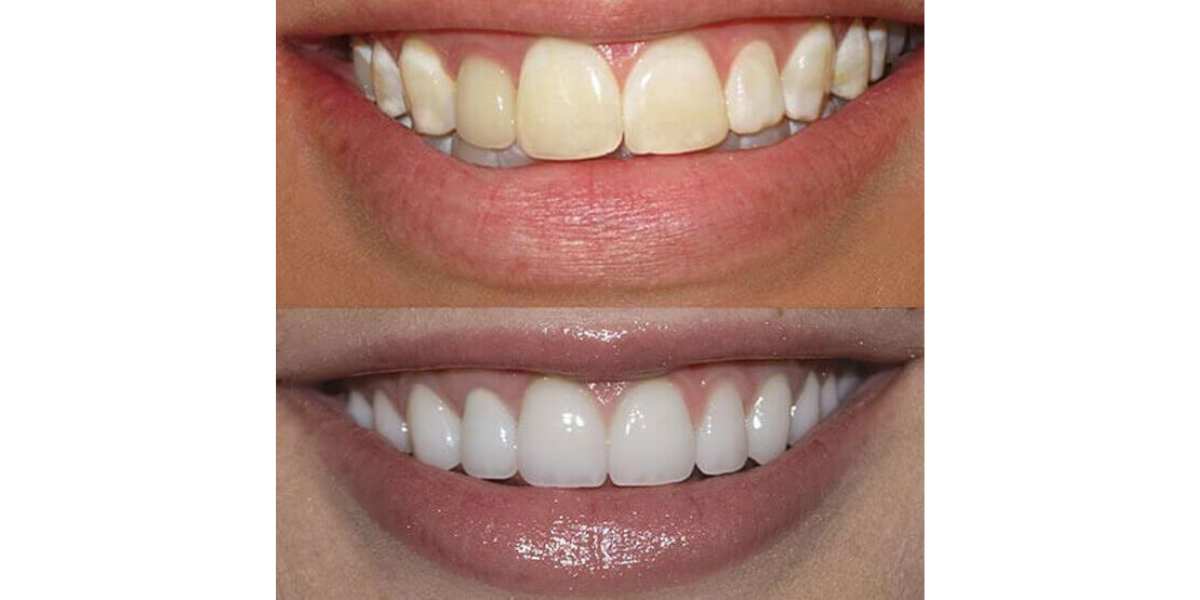 پولیش دندان چگونه است