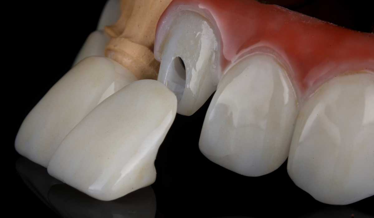 لمینت های سرامیکی