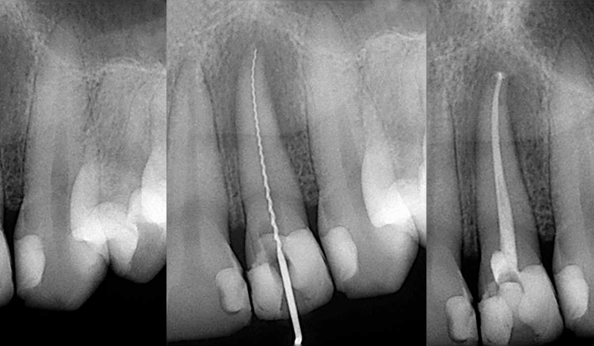ترمیم دندان با فایل دستی