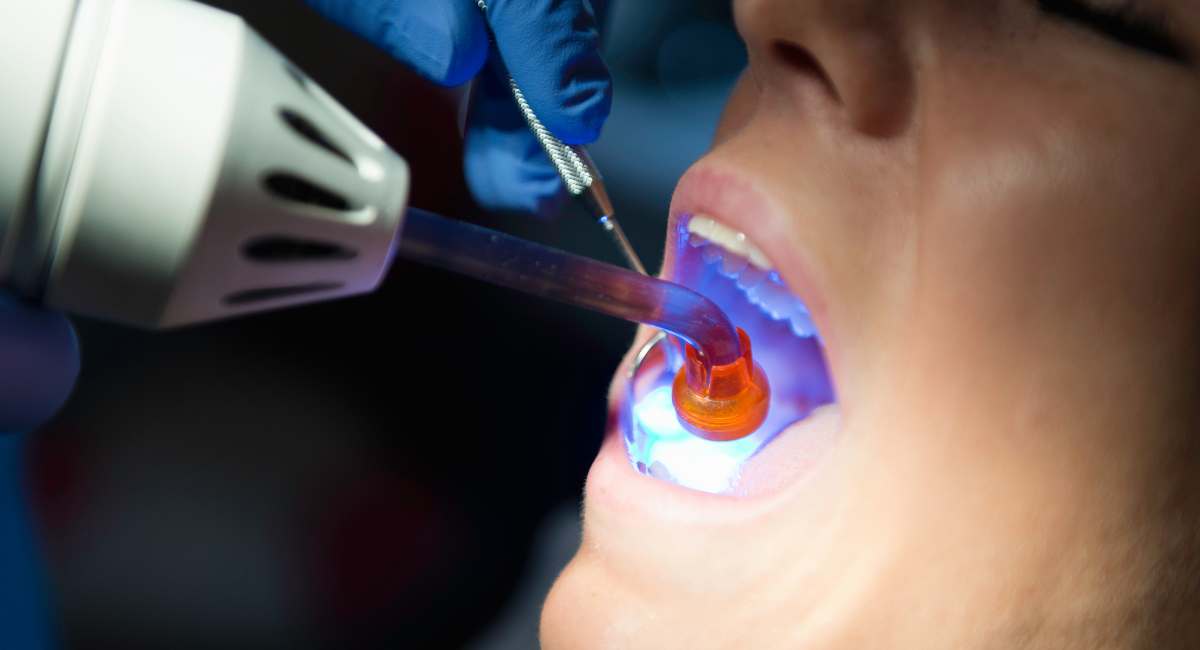 کیورینگ دندان