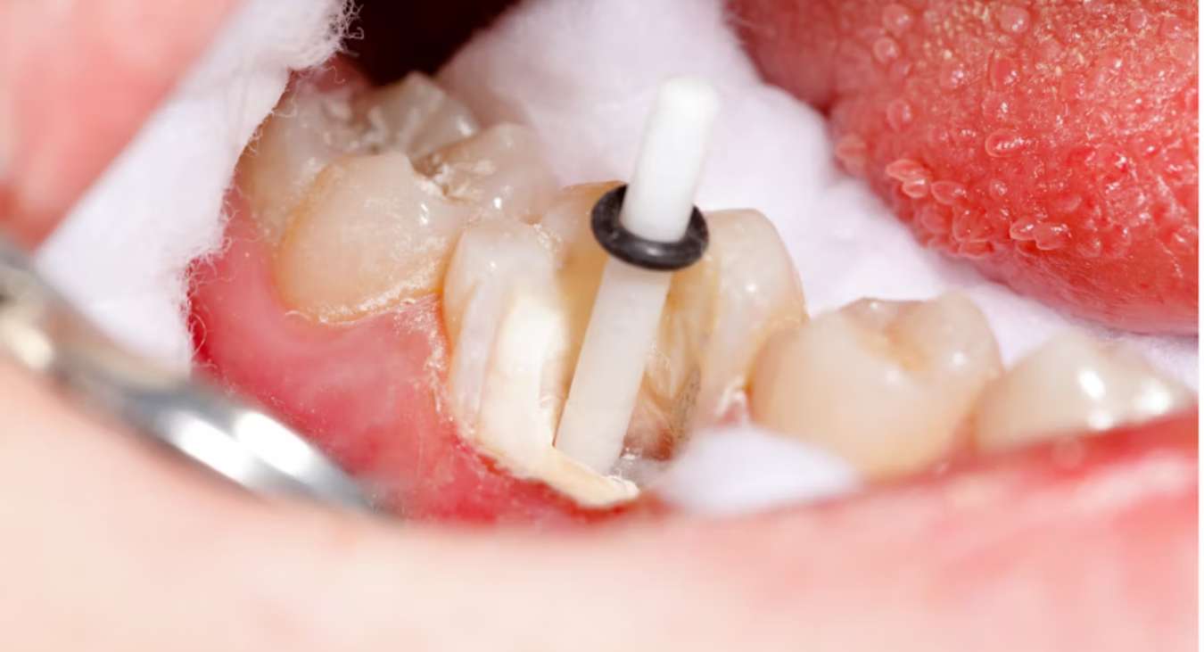 پست دندان فایبری در دندان