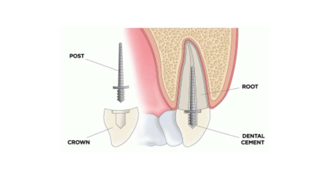 مزایای پست دندان