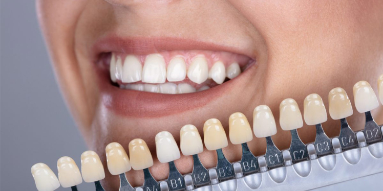 طبیعی ترین رنگ کامپوزیت دندان