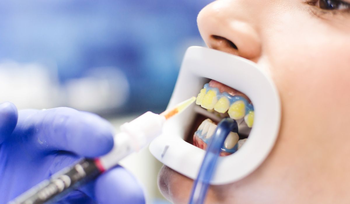 تفاوت بلیچینگ مطب و خانگی